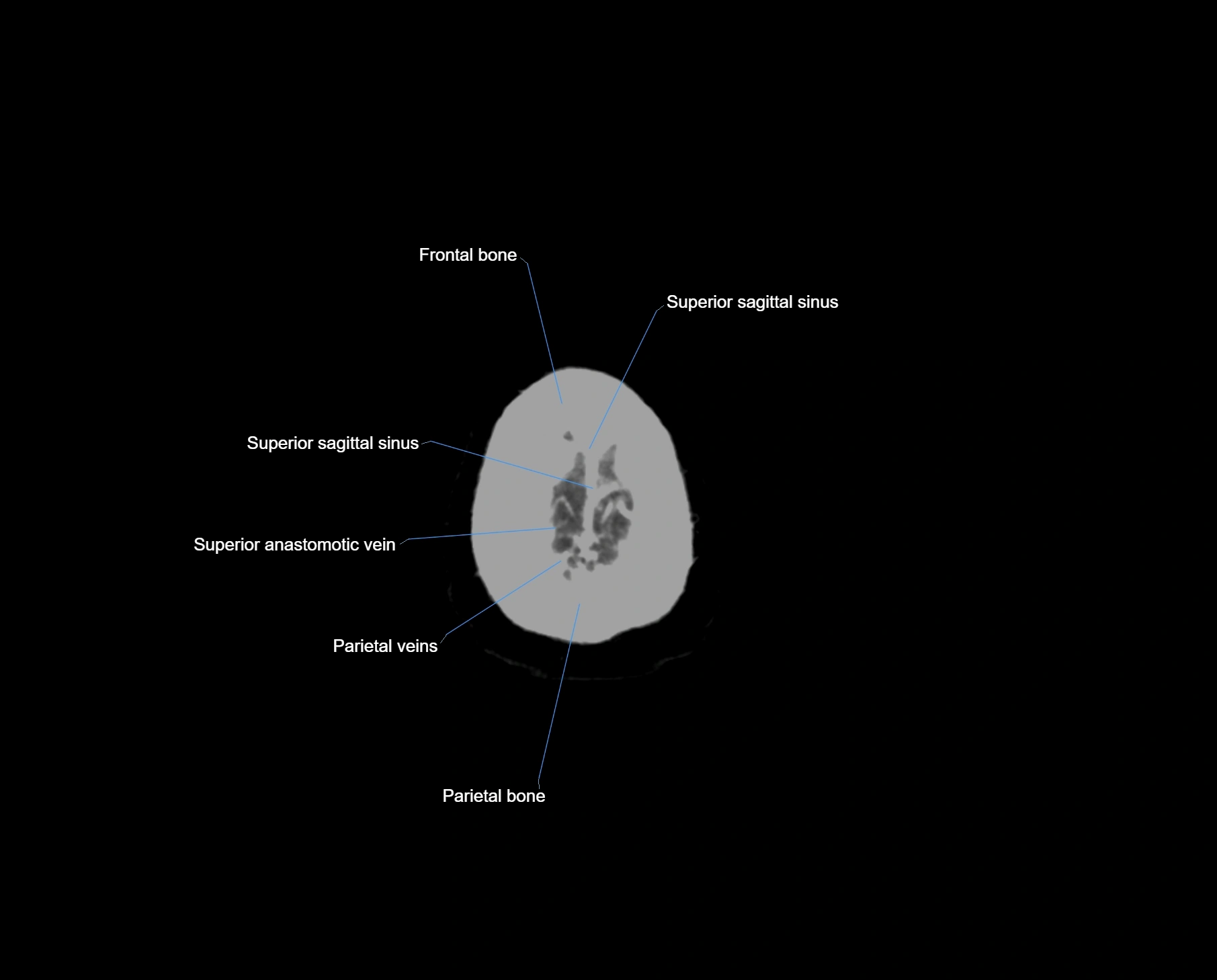 CT scan brain axial labelled cross sectional anatomy image-img-000071.webp